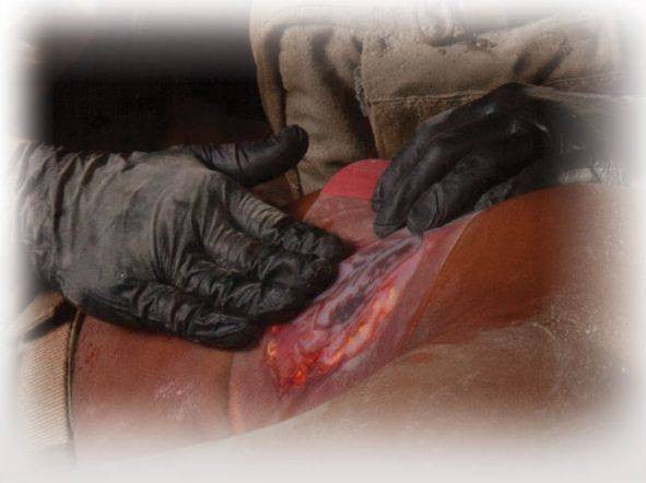  North American Rescue HyFin Chest Seal
